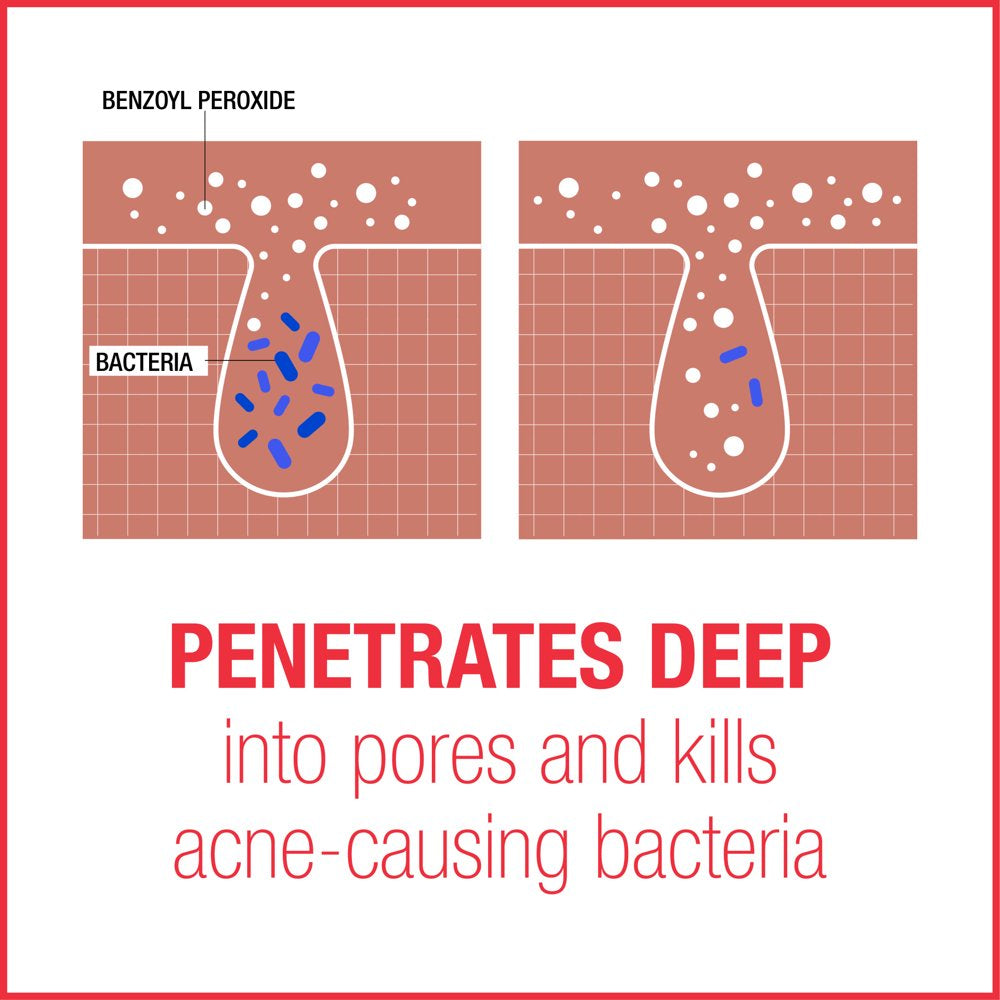 Neutrogena Stubborn Acne AM Treatment with Benzoyl Peroxide